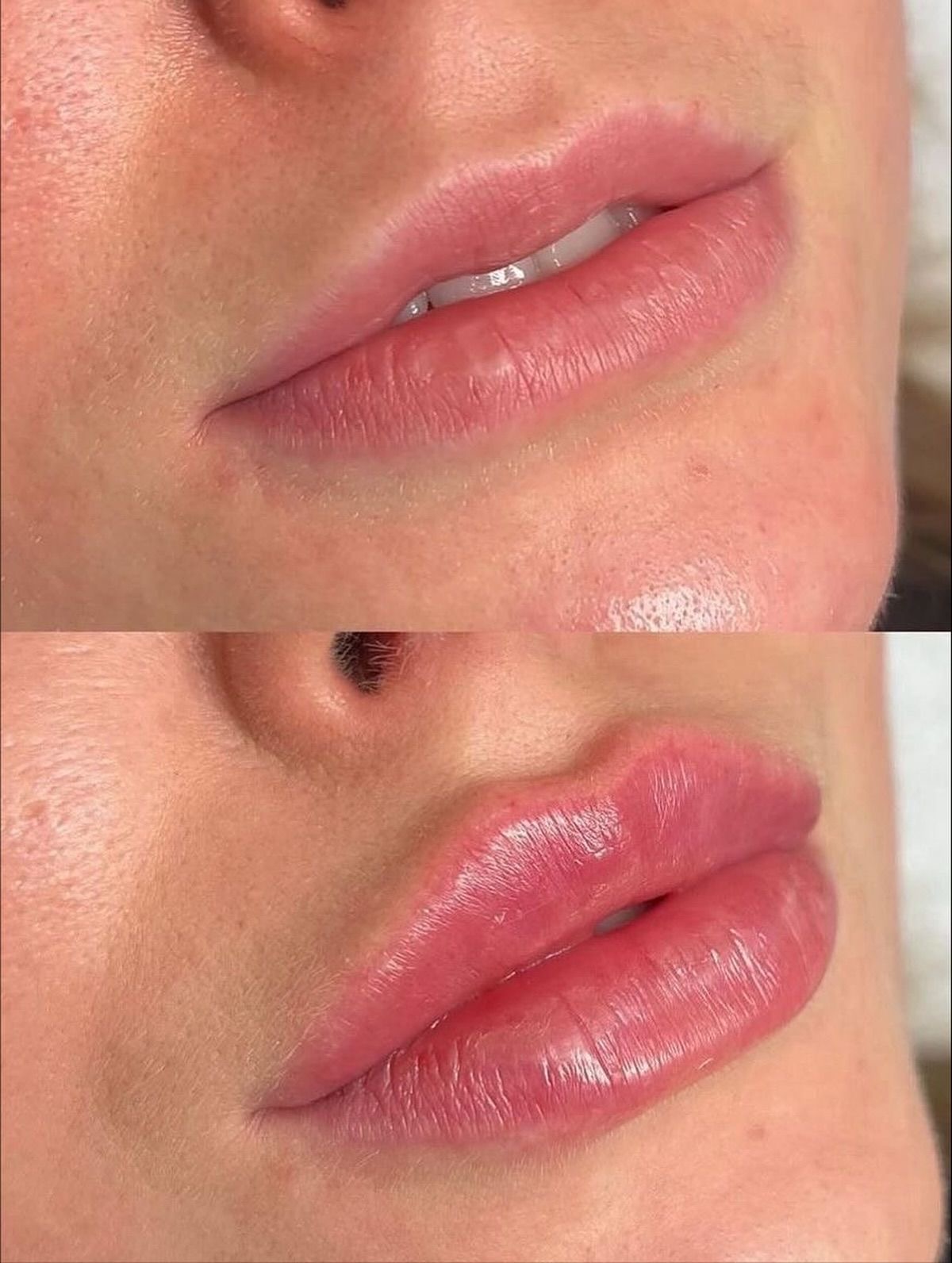 Augmentare buze acid hialuronic înainte după – Juvena Timișoara