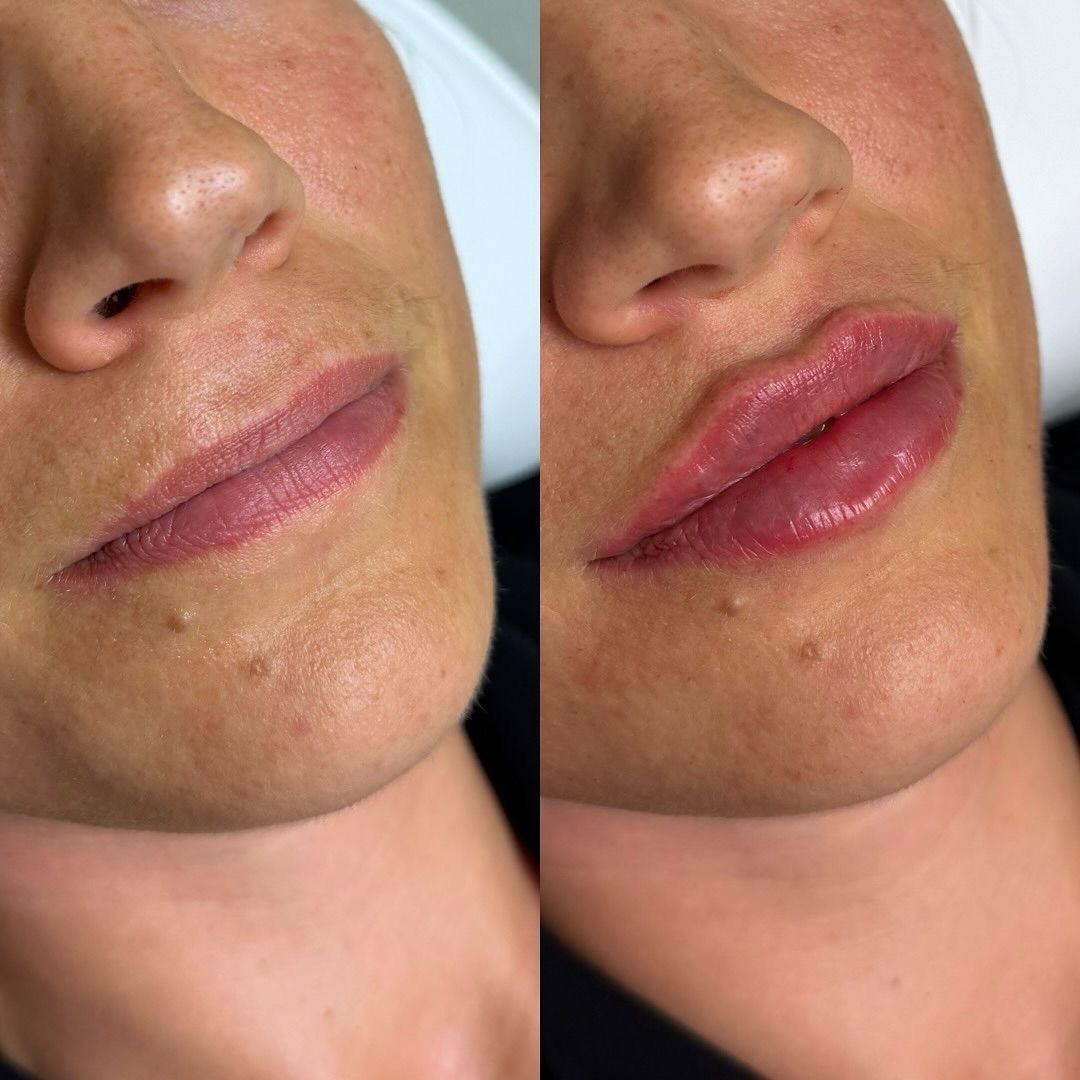 Mărire buze cu acid hialuronic rezultat înainte după – Juvena Timișoara