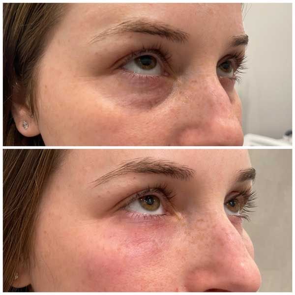 Tratament cearcăne vale lacrimale acid hialuronic înainte după – Juvena Timișoara