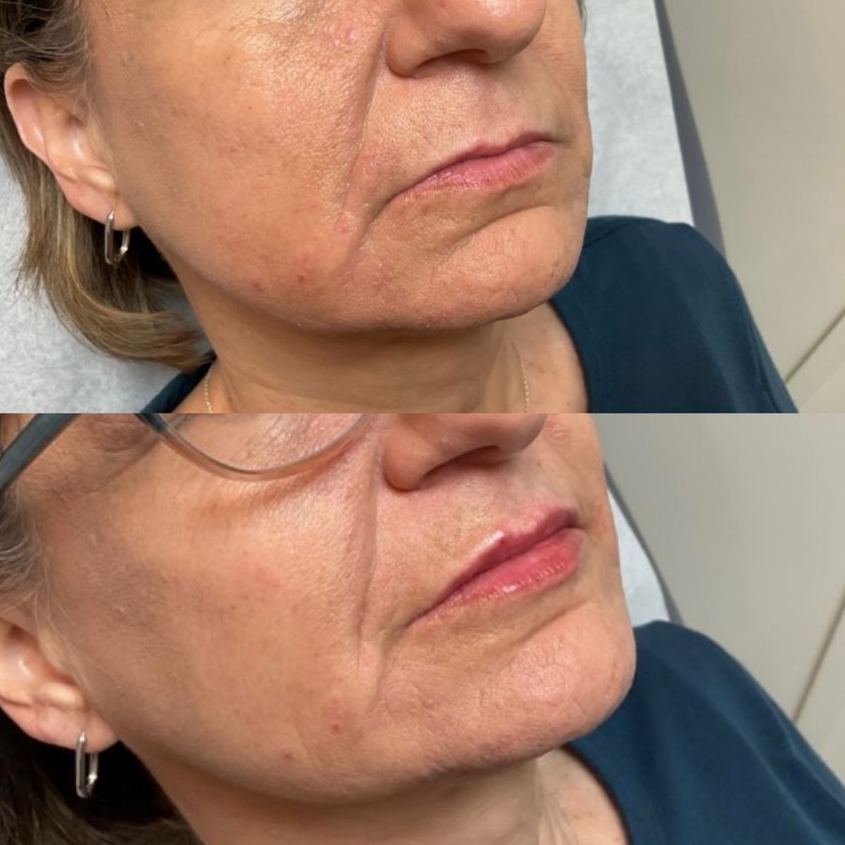 Remodelare contur facial inferior acid hialuronic înainte după – Juvena Timișoara
