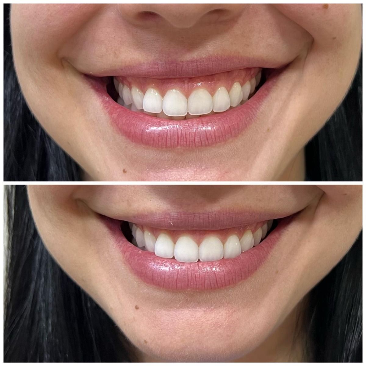 Rezultat gummy smile toxină botulinică înainte după – Juvena Timișoara