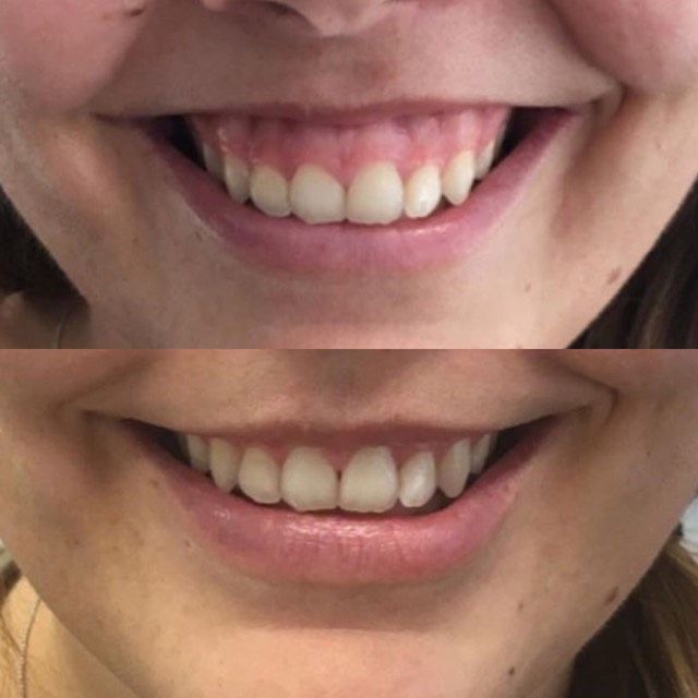 Corecție gummy smile toxină botulinică – Juvena Timișoara