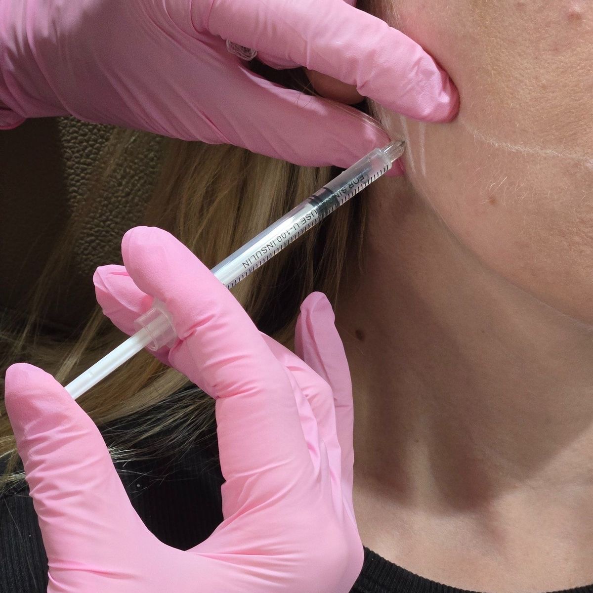 Procedură injecție maseter face slimming toxină botulinică – Juvena Timișoara