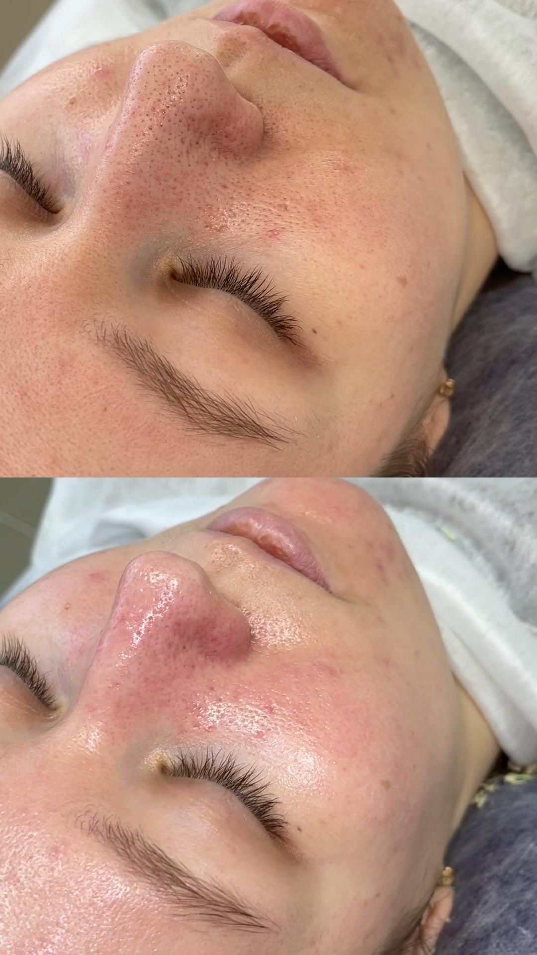 Procedură peeling chimic nas – Juvena Timișoara