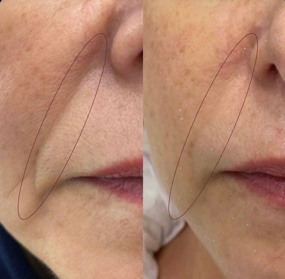 Corecție șanț nazo-labial acid hialuronic înainte după – Juvena Timișoara
